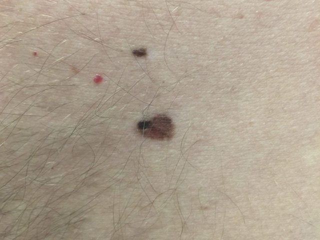 atypical nevus