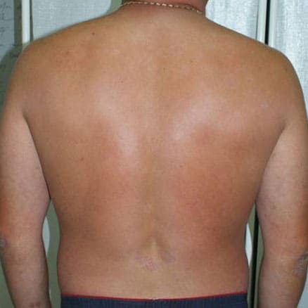 After Phototherapy on back