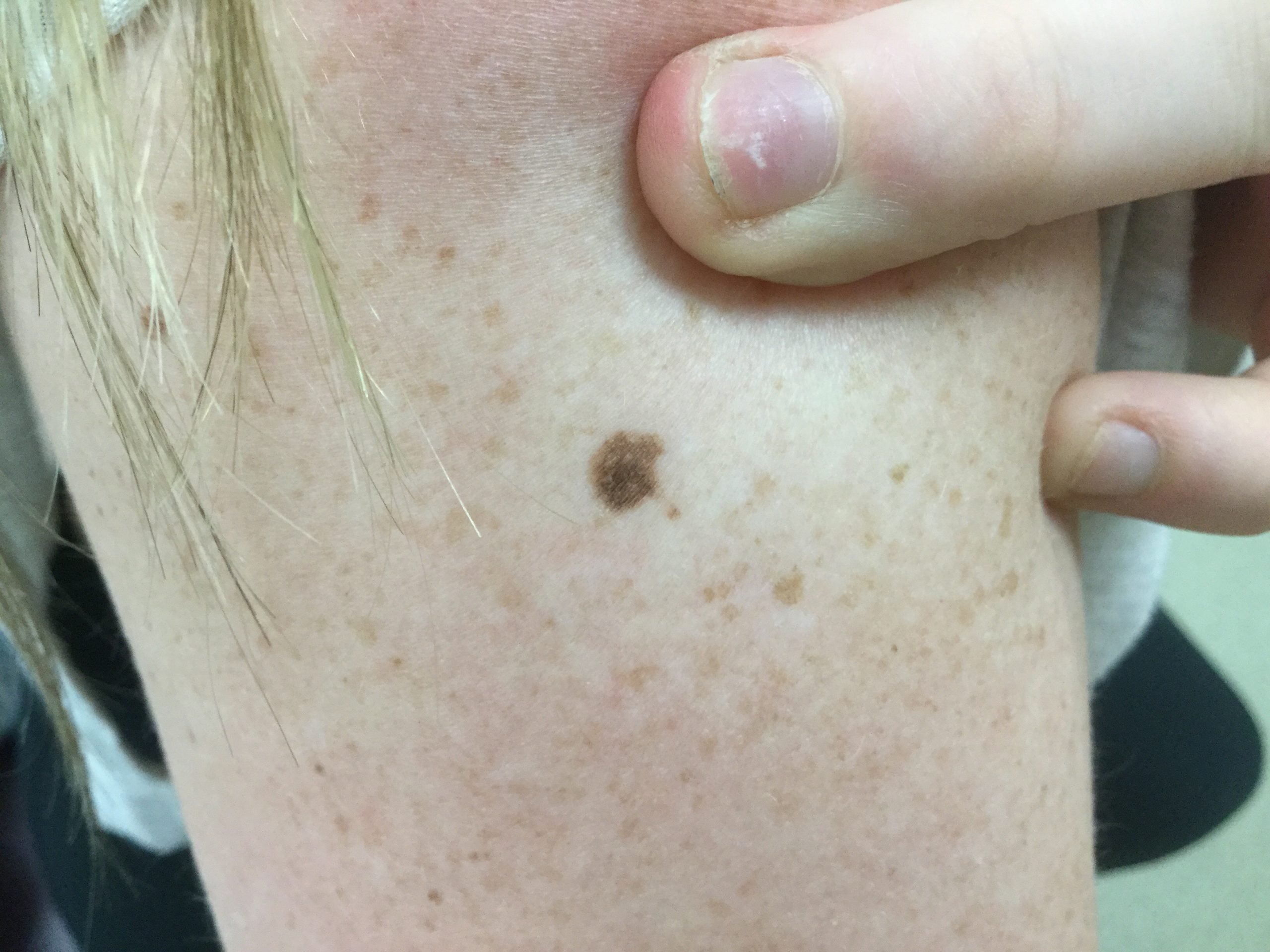 Atypical Nevus Pennsylvania Dermatology Specialists