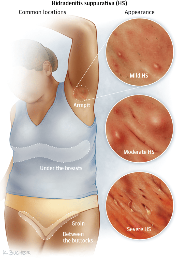 Hidradenitis suppurativa on the breasts: Prevention, treatment & more