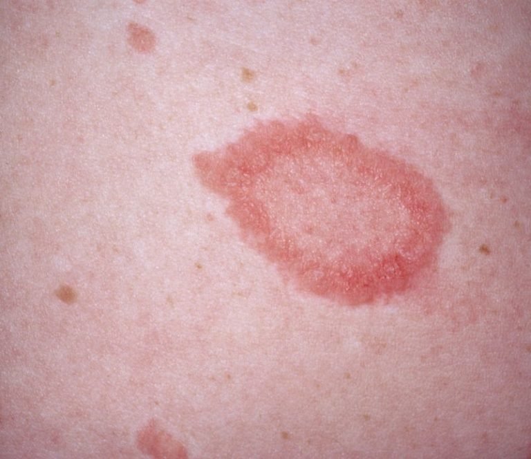 Pityriasis Rosea - Pennsylvania Dermatology Specialists