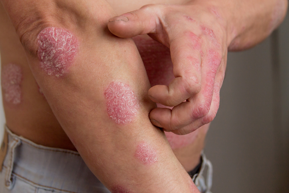 At-Home Psoriasis Care & When To See A Dermatologist